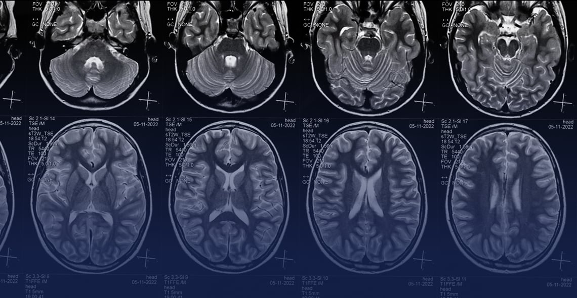We protect you after<br><i>traumatic brain injuries</i> mobile picture
